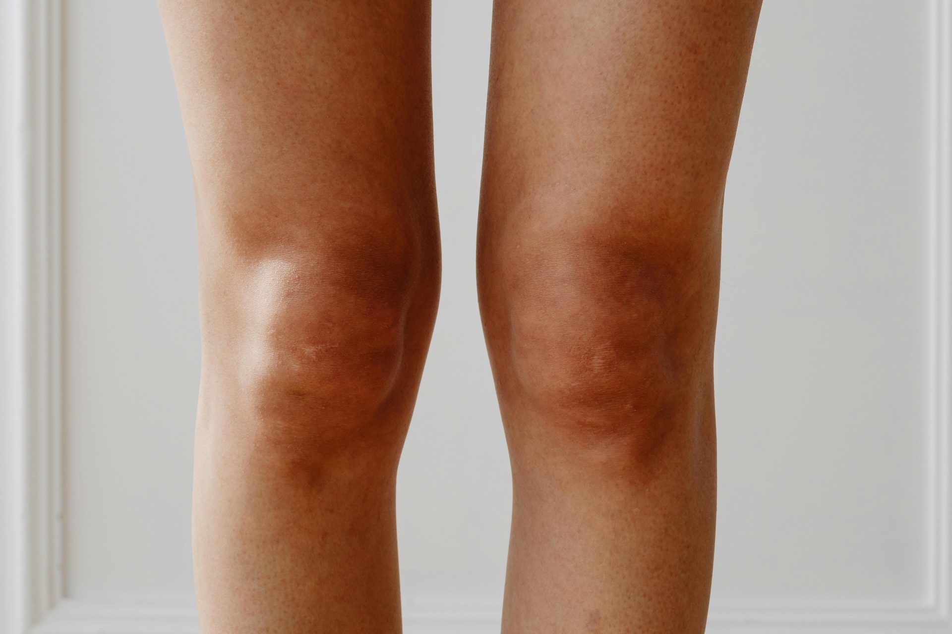 liquido nei polmoni e gambe gonfie Sconfiggere l'edema: un approccio medico professionale per ridurre il  gonfiore
